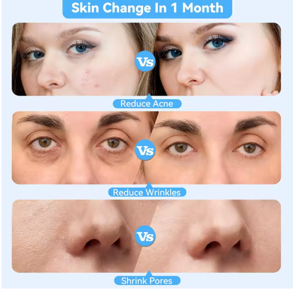 DermaSuction™ Blackhead Vacuum & Deep Pore Cleanser (Original)